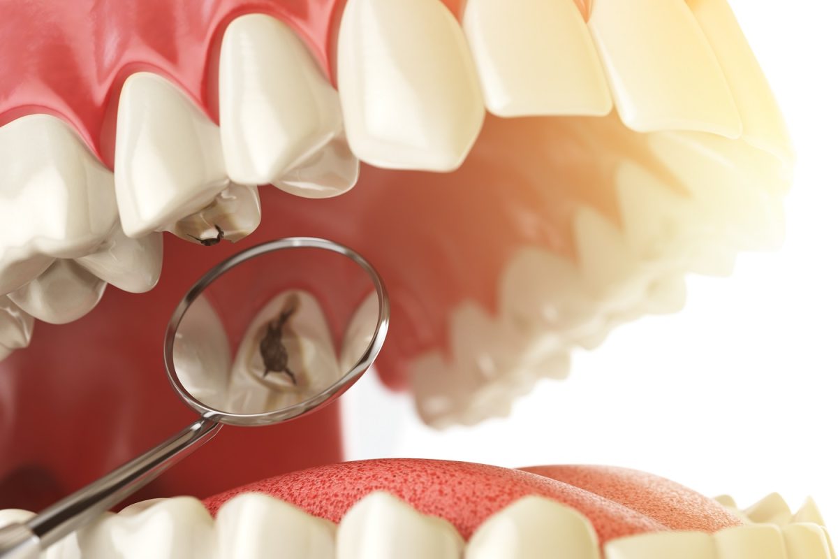 Cavity? Now What?