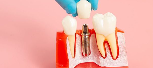 Certified Periodontist- Best Dental Implants Solution