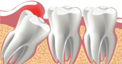 Impacted Tooth