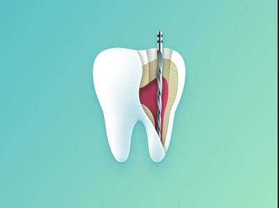Root Canals: No More Pain!