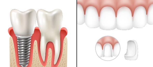 Dental Implants Vs. Veneers