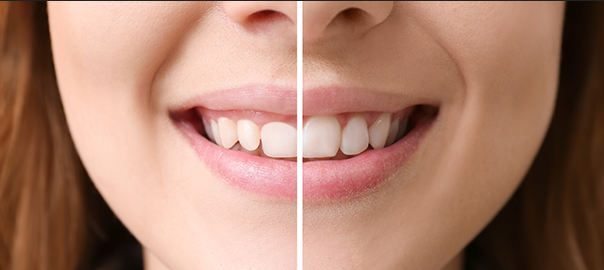 What Are The Benefits of Gum Contouring?
