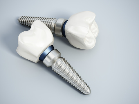 How Do I Know If I’m a Candidate for Dental Implants?